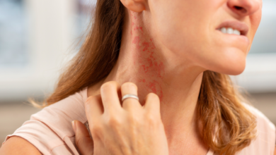 אלרגיות לתכשיטים - אישה מגרדת תגובה אלרגית בצוואר