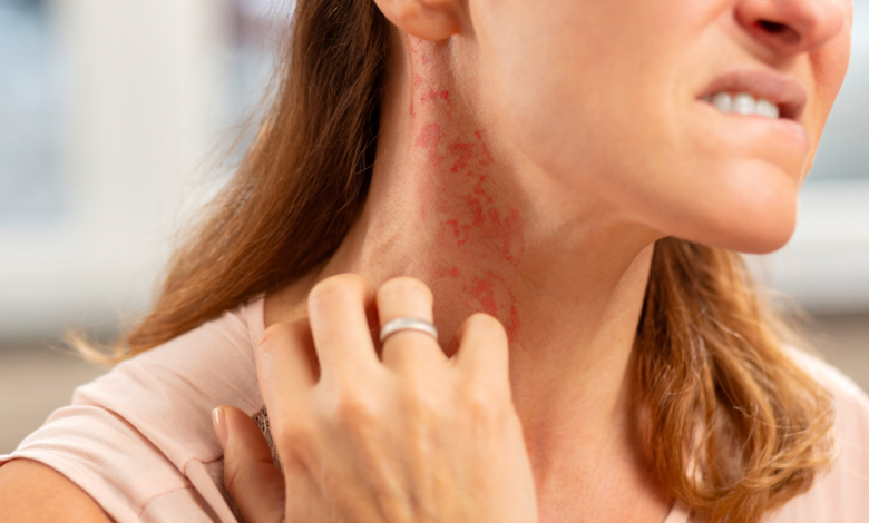 אלרגיות לתכשיטים - אישה מגרדת תגובה אלרגית בצוואר